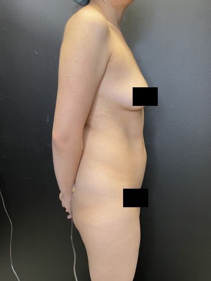 Liposuction Before & After Patient #10710