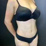 Tummy Tuck Before & After Patient #10652