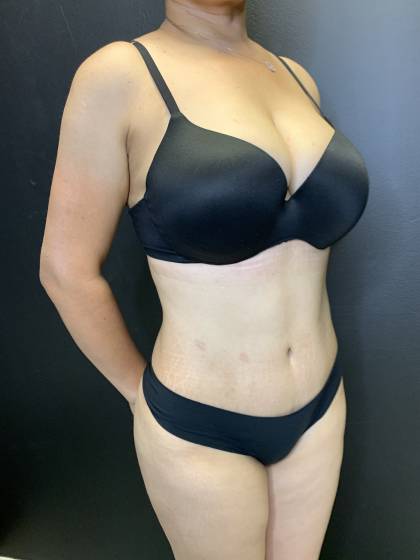 Tummy Tuck Before & After Patient #11214