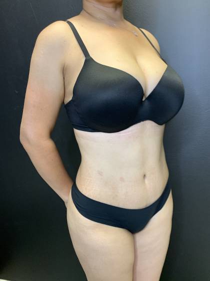 Tummy Tuck Before & After Patient #10652