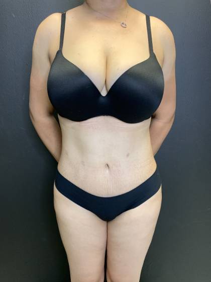 Tummy Tuck Before & After Patient #10652