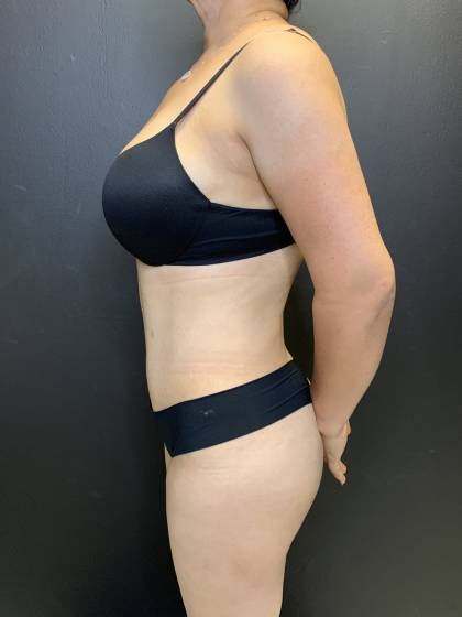 Tummy Tuck Before & After Patient #10652