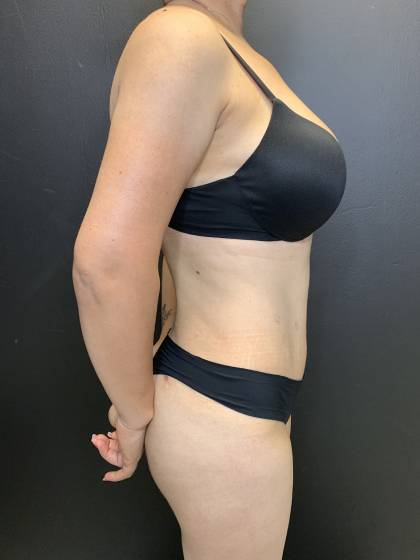 Tummy Tuck Before & After Patient #10652