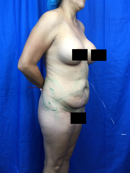 Tummy Tuck Before & After Patient #11214