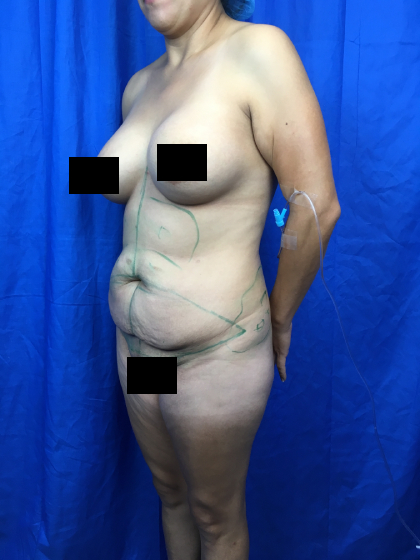 Brazilian Butt Lift Before & After Patient #11214