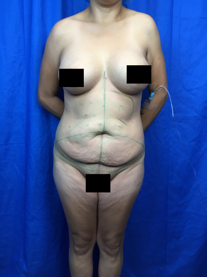 Brazilian Butt Lift Before & After Patient #11214