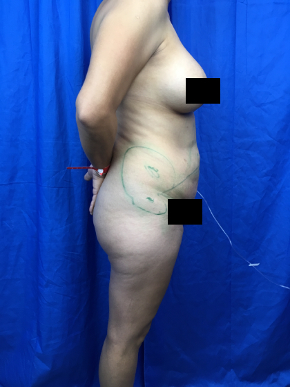Brazilian Butt Lift Before & After Patient #11214