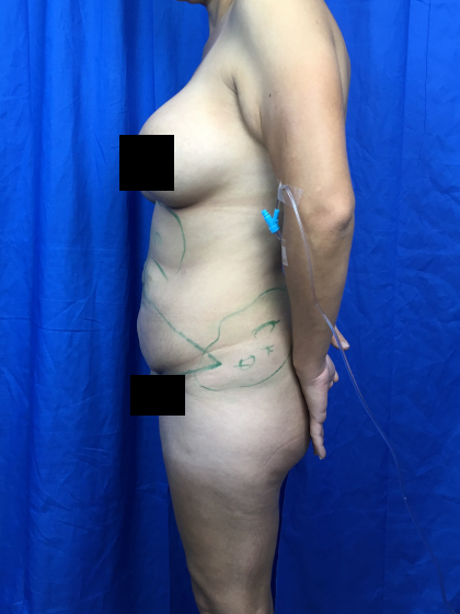 Tummy Tuck Before & After Patient #11214