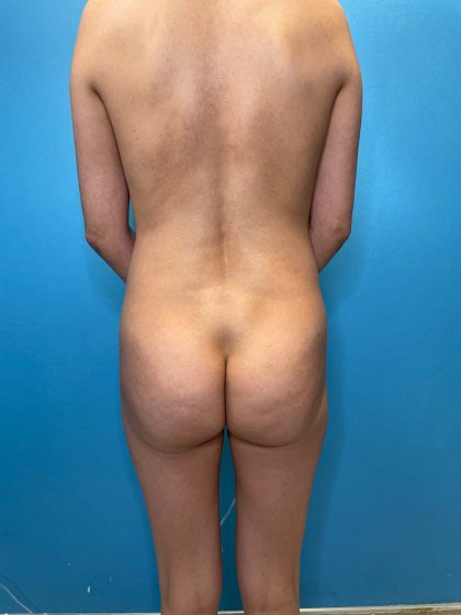 Brazilian Butt Lift Before & After Patient #11213