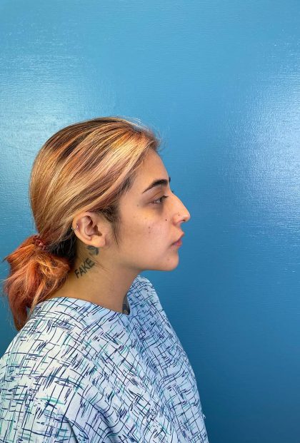 Rhinoplasty Before & After Patient #10811