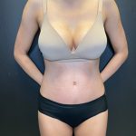Tummy Tuck Before & After Patient #10794