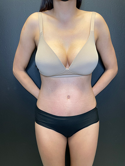 Tummy Tuck Before & After Patient #10794