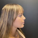 Rhinoplasty Before & After Patient #10871