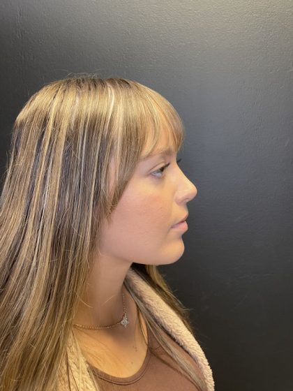 Rhinoplasty Before & After Patient #10871