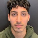 Rhinoplasty Before & After Patient #11036