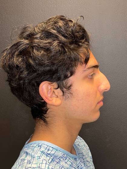 Rhinoplasty Before & After Patient #11036