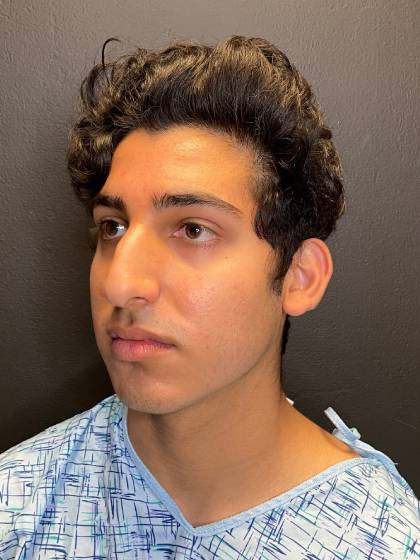 Rhinoplasty Before & After Patient #11036