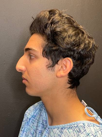 Rhinoplasty Before & After Patient #11036