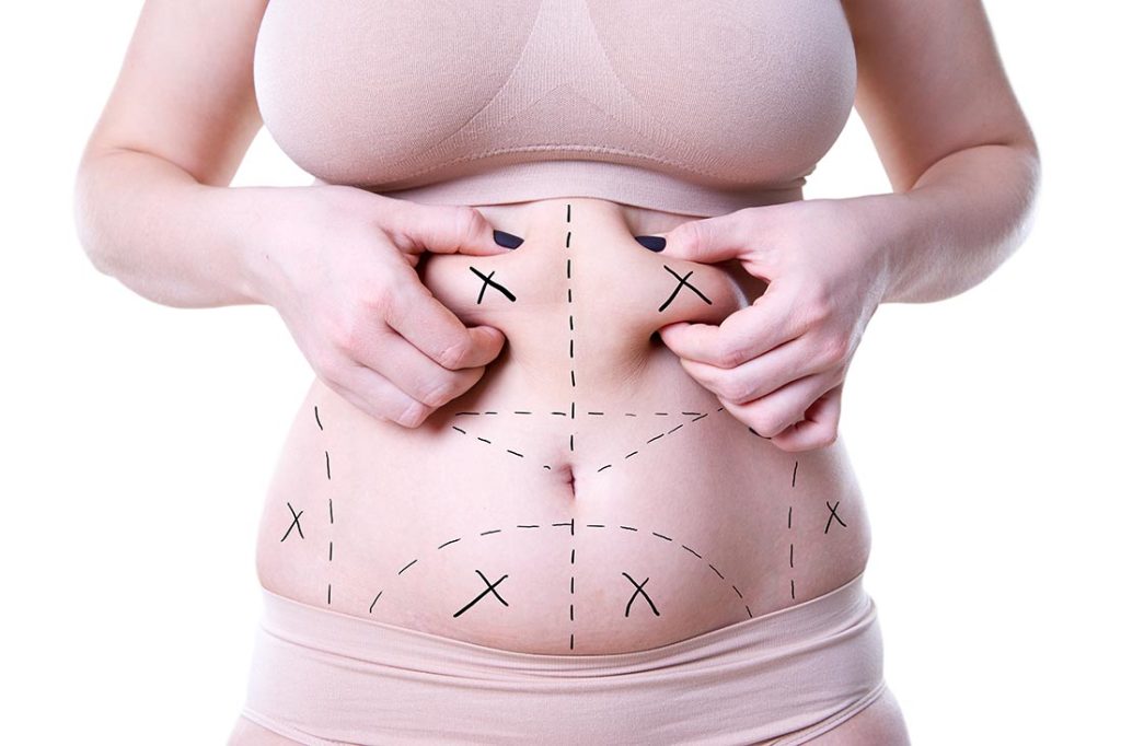 Woman's mid section market up for a tummy tuck. Michael Omidi.