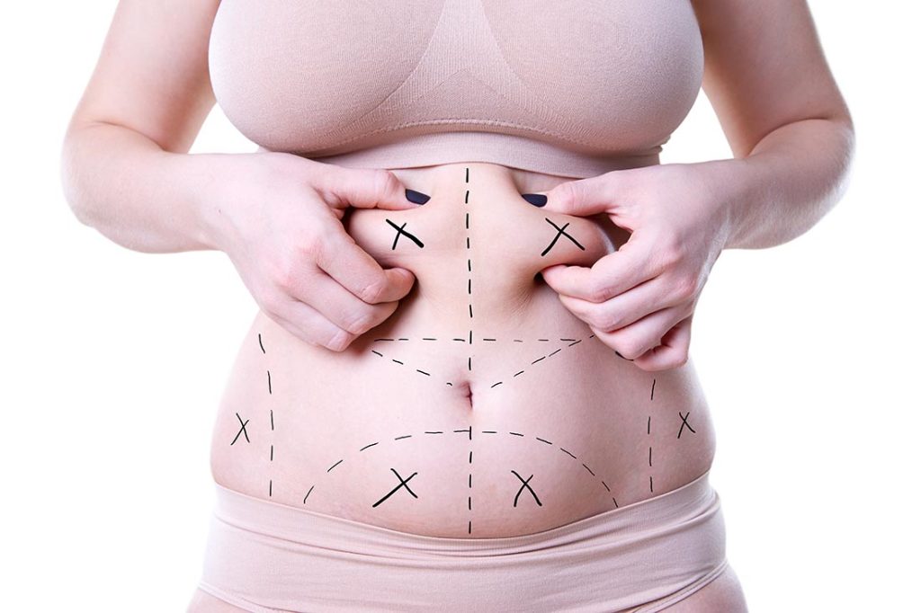 Best Full Tummy Tuck Los Angeles & Beverly Hills, CA