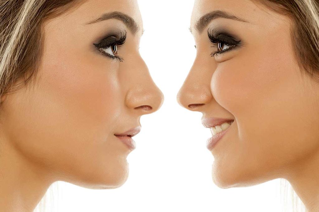 Woman before and after rhinoplasty. Middle Eastern rhinoplasty Dr. Michael Omidi.