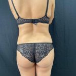 Lower Buttock Lift/Gluteal Fold Reconstruction Before & After Patient #11332