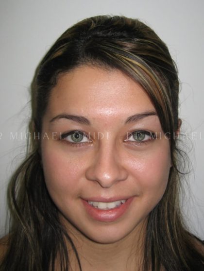 Otoplasty Before & After Patient #11380