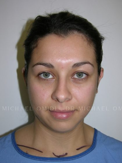 Otoplasty Before & After Patient #11380