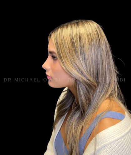 Rhinoplasty Before & After Patient #11352