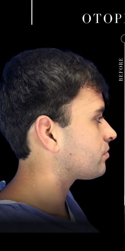 Ear Pinning (Otoplasty) Before & After Patient #11419
