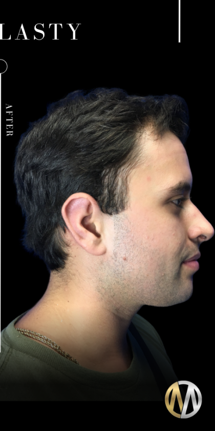 Ear Pinning (Otoplasty) Before & After Patient #11419