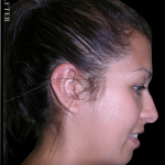 Ear Pinning (Otoplasty) Before & After Patient #11399