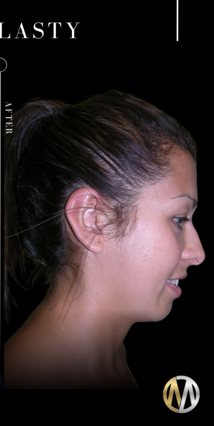 Ear Pinning (Otoplasty) Before & After Patient #11399