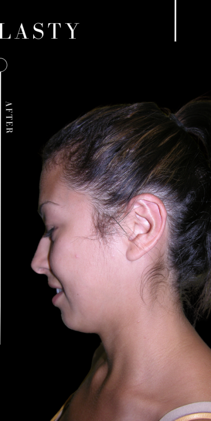 Ear Pinning (Otoplasty) Before & After Patient #11399