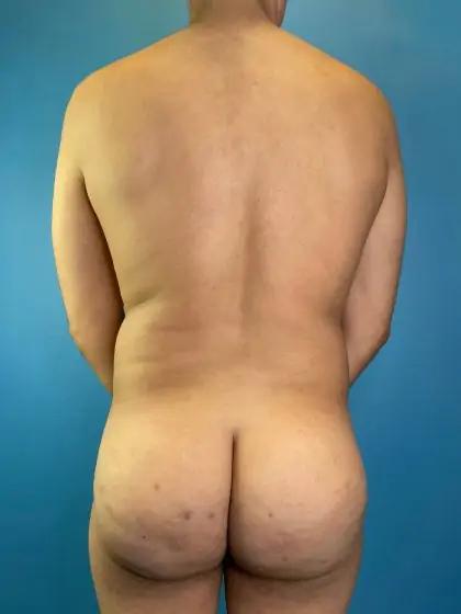 Liposuction Before & After Patient #11493