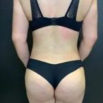 Brazilian Butt Lift Before & After Patient #11519