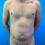 Liposuction Before & After Patient #11493