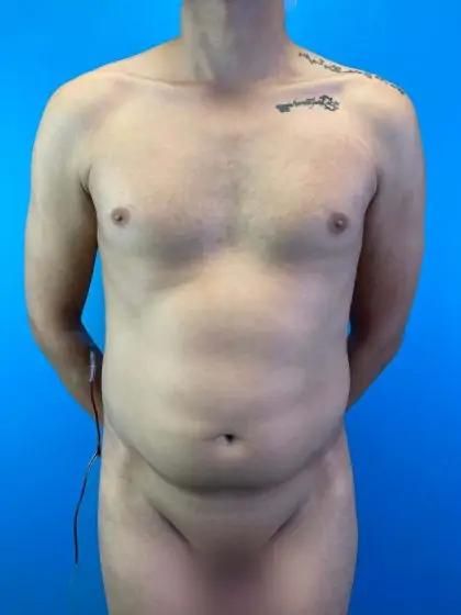 Liposuction Before & After Patient #11493