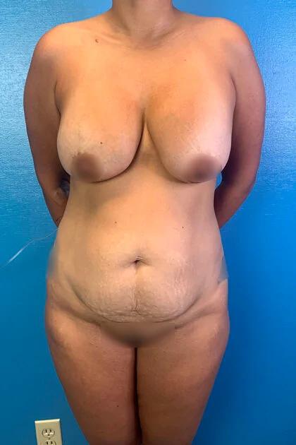 Liposuction Before & After Patient #11467