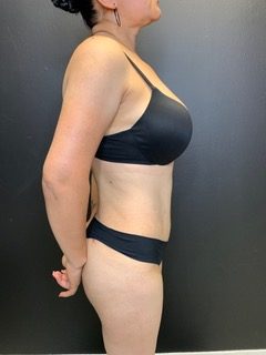 Brazilian Butt Lift Before & After Patient #11519