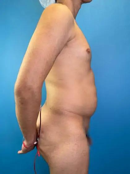 Liposuction Before & After Patient #11493