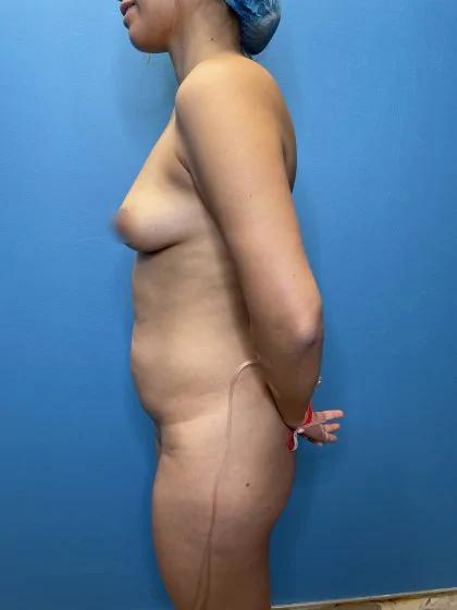 Liposuction Before & After Patient #11480