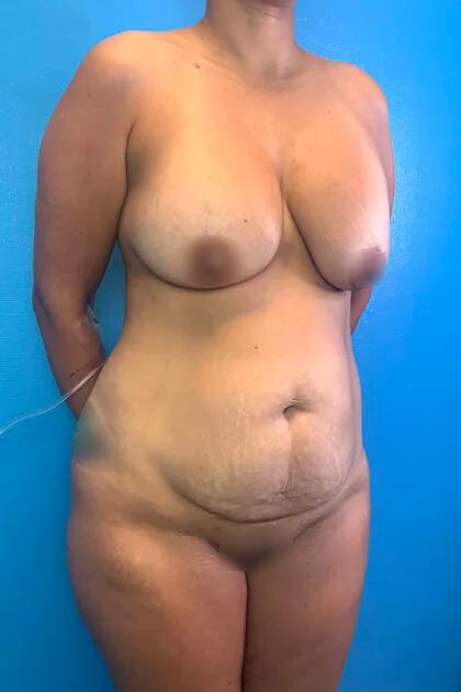 Liposuction Before & After Patient #11467