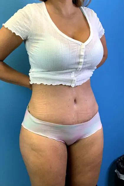 Liposuction Before & After Patient #11467