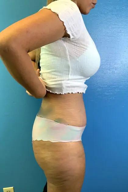 Liposuction Before & After Patient #11467