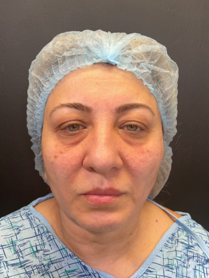 Brow Lift and Blepharoplasty (Eyelid Surgery) Before & After Patient #11687