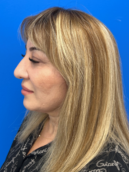 Brow Lift and Blepharoplasty (Eyelid Surgery) Before & After Patient #11687