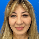 Brow Lift and Blepharoplasty (Eyelid Surgery) Before & After Patient #11687
