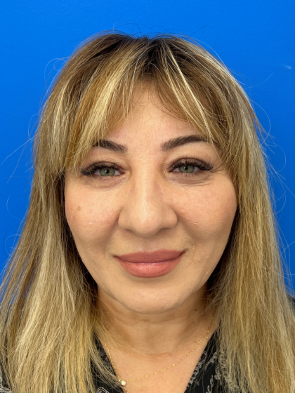 Brow Lift and Blepharoplasty (Eyelid Surgery) Before & After Patient #11687