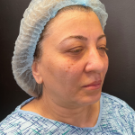 Brow Lift and Blepharoplasty (Eyelid Surgery) Before & After Patient #11687